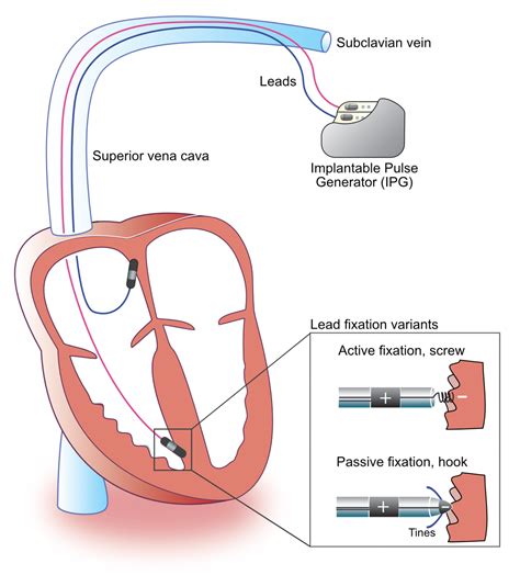 electrical transformer box and pacemaker interference|can implanted devices interfere with pacemakers.